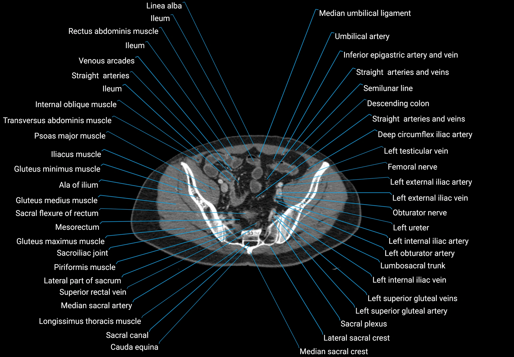 CT male pelvis axial cross sectional anatomy labelled radiology image -00158.webp